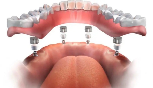 結語：種牙選對醫(yī)生，就是選對生活質量