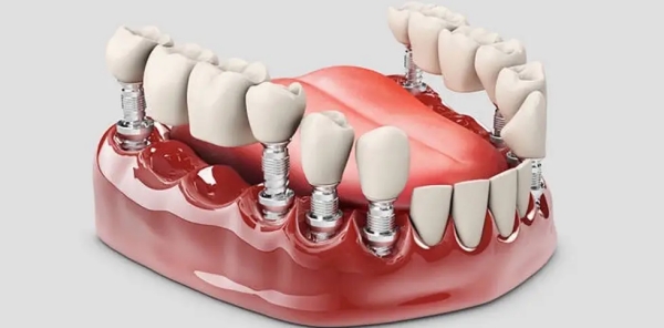 Q4：種植牙價(jià)格貴嗎？有沒(méi)有優(yōu)惠？ardc-srvc.com