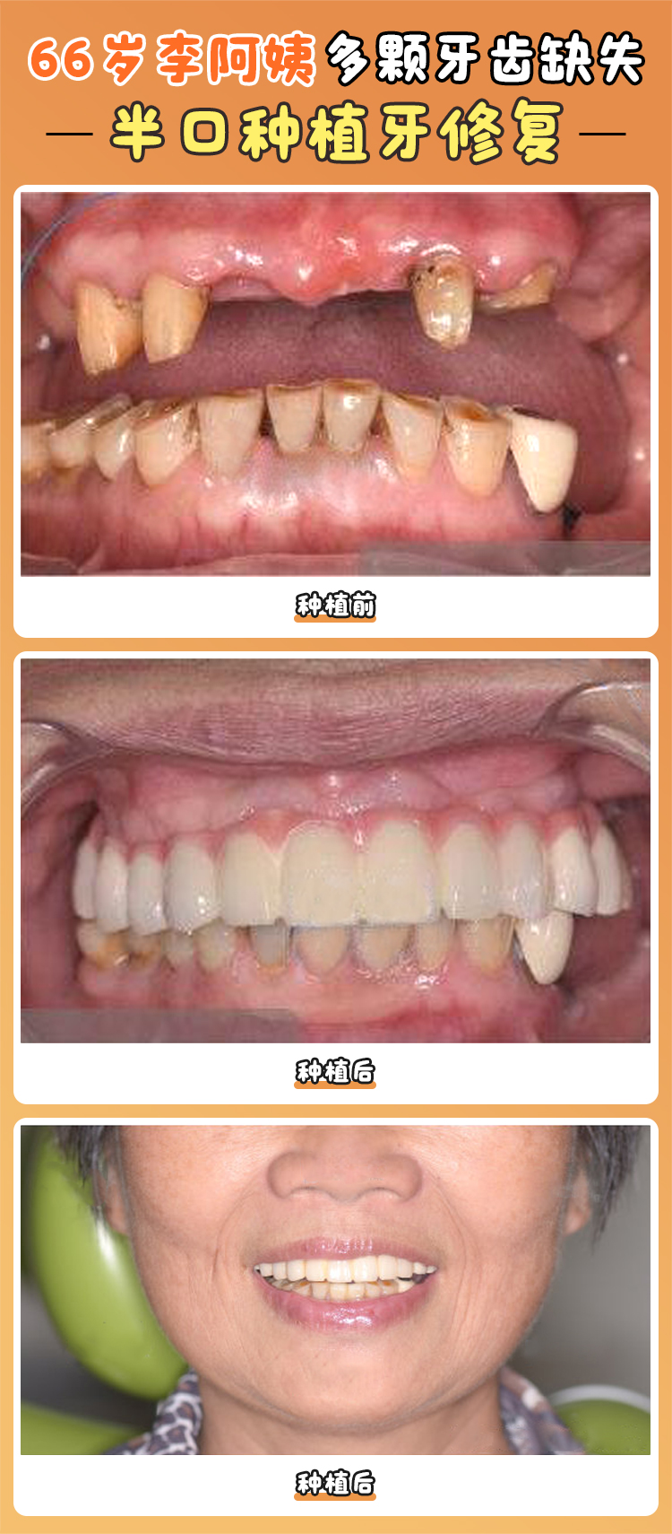 長(zhǎng)沙天心安瑞口腔諶志遠(yuǎn)醫(yī)生種植牙技術(shù)：3種高端技術(shù)破解復(fù)雜難題