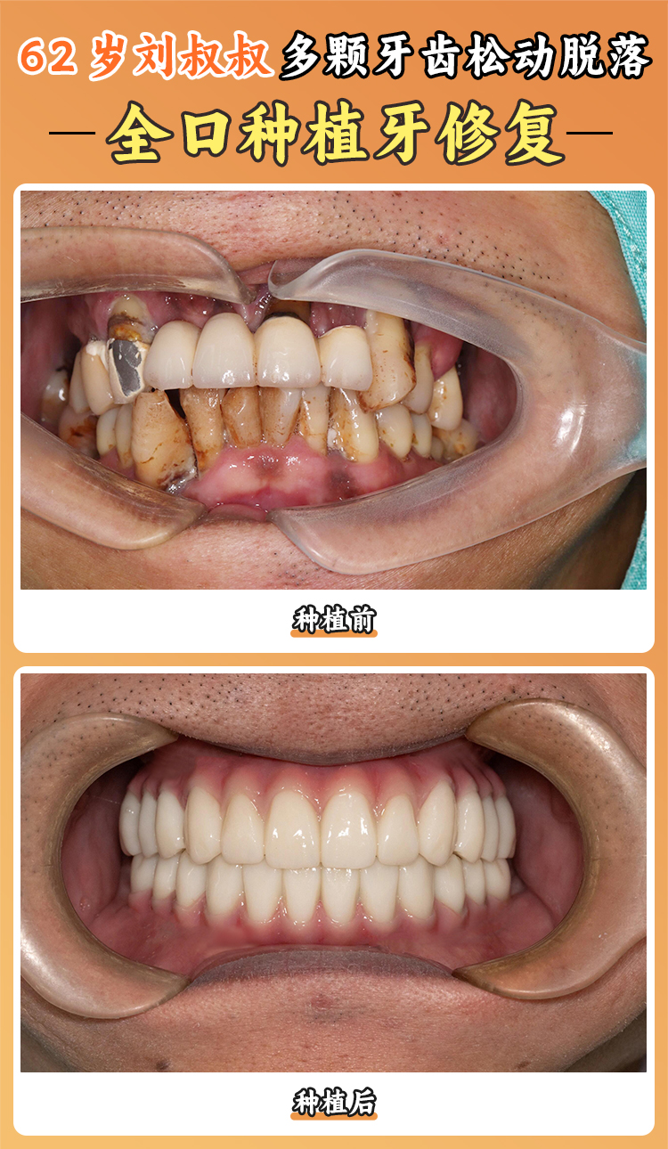 長(zhǎng)沙天心安瑞口腔諶志遠(yuǎn)醫(yī)生種植牙服務(wù)：5大特色+6項(xiàng)貼心舉措讓患者安心www.ardc-srvc.com