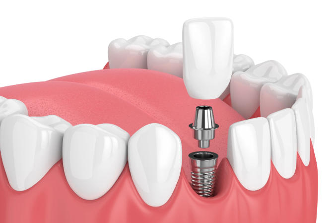 三、深圳龍崗區(qū)十大牙科價(jià)格橫向?qū)Ρ?></p><h3>三、深圳龍崗區(qū)十大牙科價(jià)格橫向?qū)Ρ?/h3><p>根據(jù)調(diào)研數(shù)據(jù)，選取同類型治療項(xiàng)目進(jìn)行對比分析：</p><p>1. 種植牙價(jià)格區(qū)間對比：</p><table class=