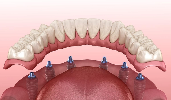 四、種植牙術(shù)后護(hù)理與使用壽命