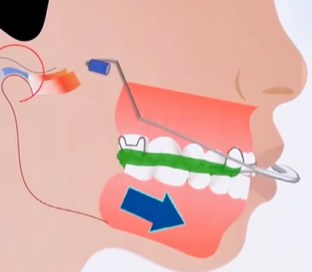 親測霸州雅美正畸技術！隱適美矯正后，深覆合和中線不齊全搞定