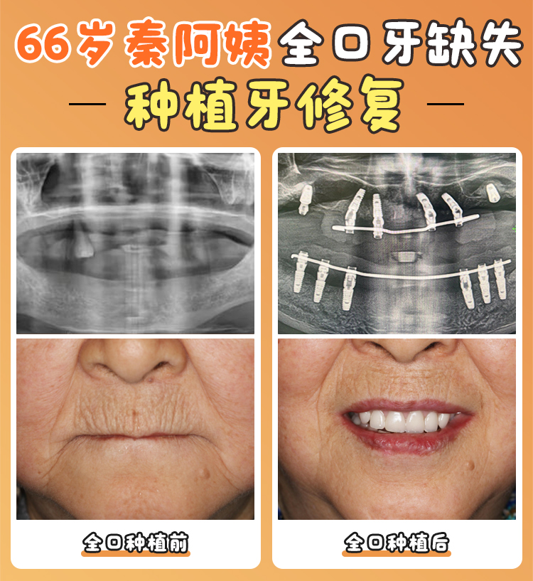 三、煙臺(tái)膠東半島口腔種植牙可能涉及的附加項(xiàng)目及費(fèi)用