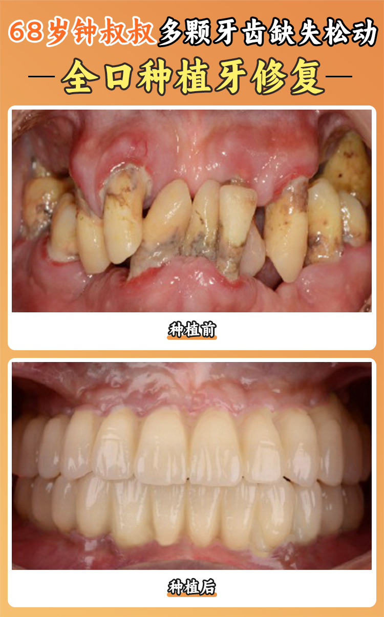 義烏拜博口腔種植牙口碑爆了！附種植醫(yī)生名單+真實案例，種牙不再踩坑