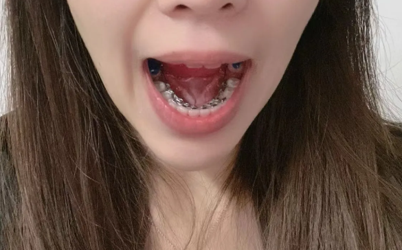 深圳舌側(cè)矯正哪家醫(yī)院比較好？2026年新版5家口碑醫(yī)院對比，避坑指南來了