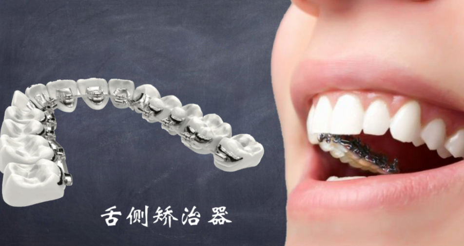 三、深圳舌側(cè)矯正醫(yī)院就診攻略