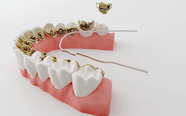 五、深圳舌側(cè)矯正的常見問題解答