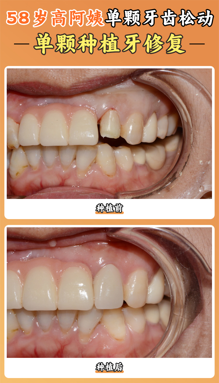 阜陽愛齒口腔價(jià)目表2026新版！種植牙1980元起/顆，比公立醫(yī)院便宜30%