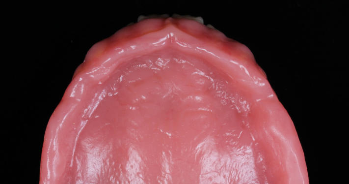 五、廈門吸附性義齒技術(shù)解析：從原理到護理的全方面指南