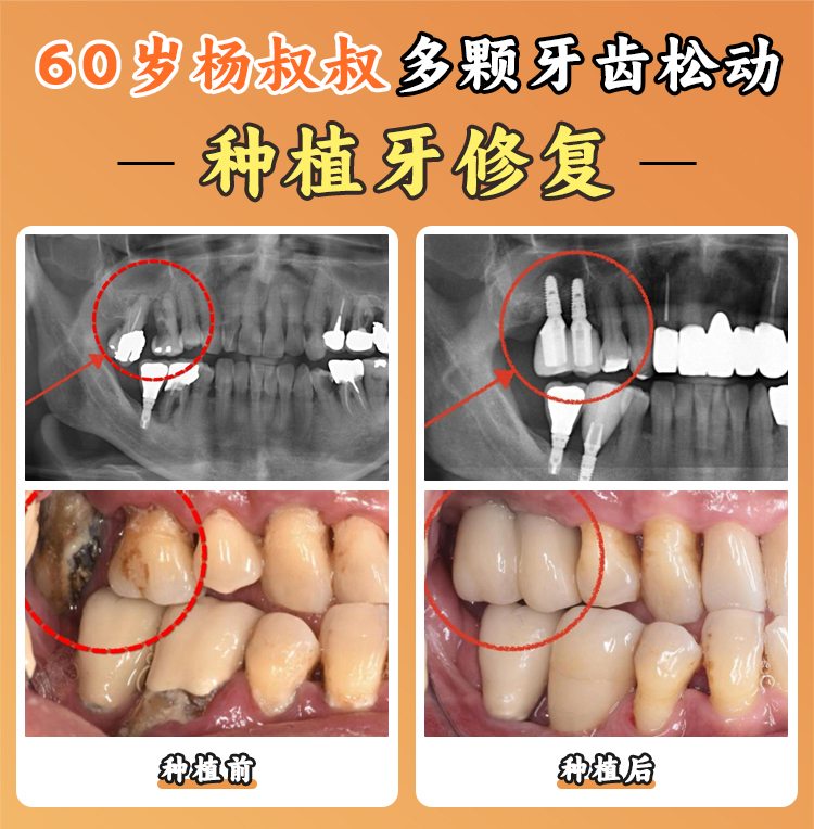 西安中?？谇环N植牙價格多少錢？碑林區(qū)性價比之選，韓國易普萊低至1880元
