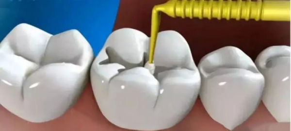 三門博雅口腔收費(fèi)標(biāo)準(zhǔn)： 補(bǔ)牙不到200塊起，性價(jià)比在三門算頭一梯隊(duì)