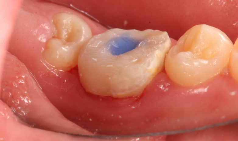 六、補(bǔ)牙后護(hù)理與常見問題