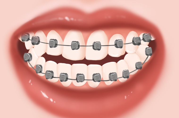 昆明正畸廖文琴醫(yī)生口碑怎么樣？嘴凸矯正內(nèi)收自然，隱形矯正認(rèn)證醫(yī)師，面部線條改善超明顯！