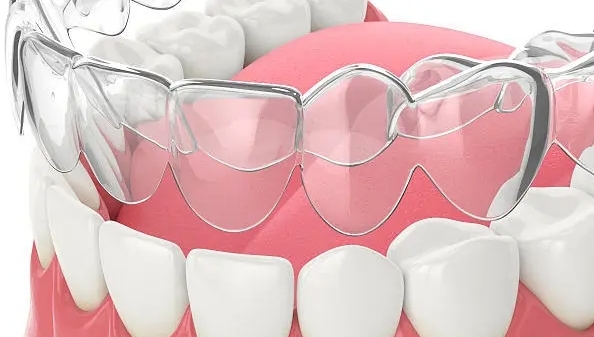 太原隱形矯正牙齒多少錢？本地姐妹拆解所有收費(fèi)項