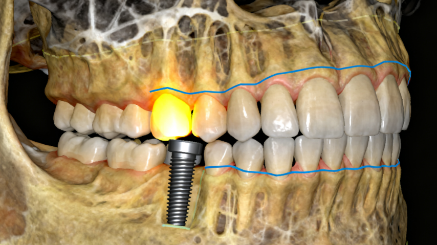 五、深圳公明牙科醫(yī)院特色項(xiàng)目解析：從種植牙到兒童防齲