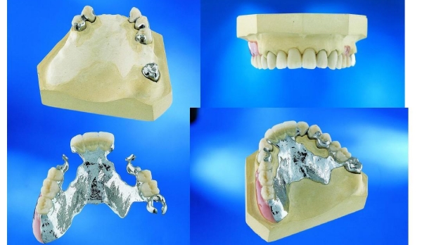 黃廣泉義齒靠譜嗎？靠譜！98%用戶滿意，啃蘋果不掉，中性區(qū)技術(shù)讓全口義齒穩(wěn)如真牙！