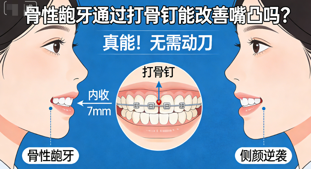 骨性齙牙通過打骨釘能改善嘴成效好