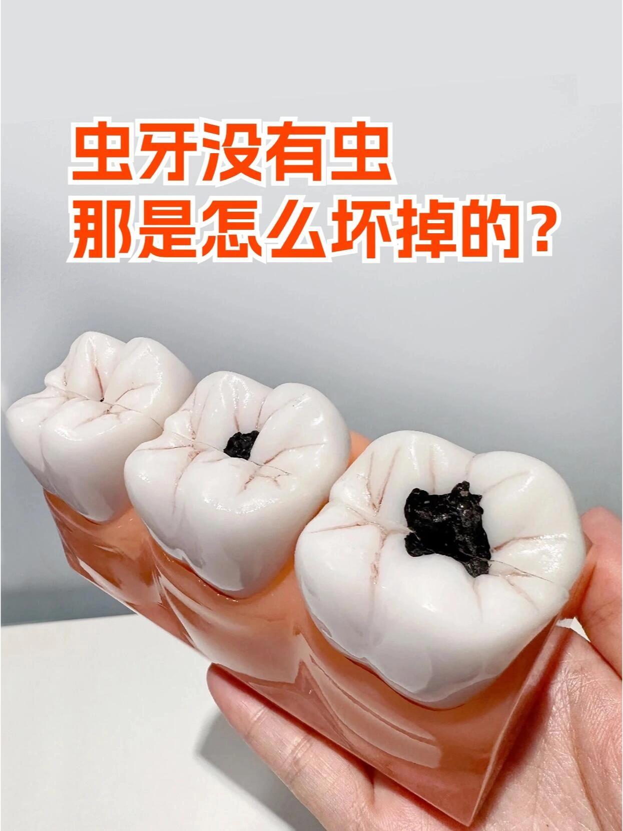 保護上頜6號牙：從識別形態(tài)到科學預防