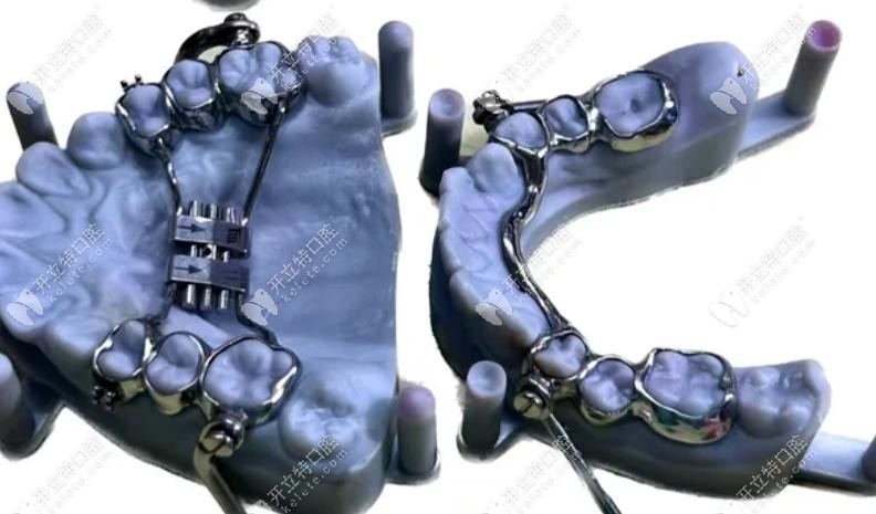 Herbst矯治器矯正下頜后縮核心原理：