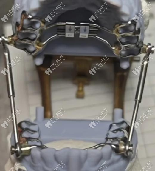 Herbst矯治器矯正下頜后縮術(shù)后成效