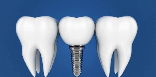 五、選擇寶雞大團(tuán)圓口腔醫(yī)院種植牙需要注意什么