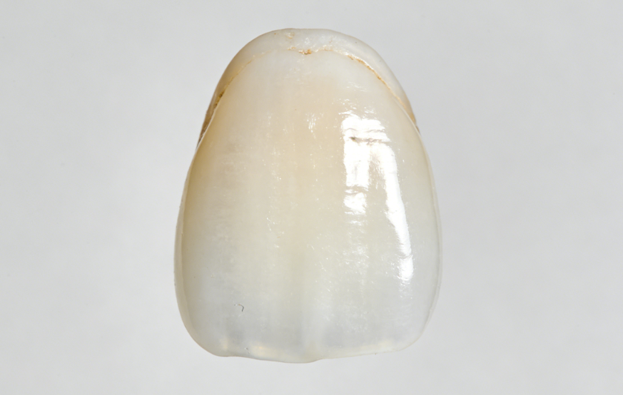 杭州齊爾口腔牙齒貼片評(píng)價(jià)為什么這么高？拱墅區(qū)姐妹私藏的美牙黑科技，揭秘其不磨牙微創(chuàng)技術(shù)