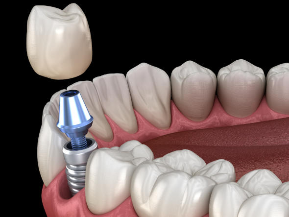 十、深圳維尼口腔值得選擇嗎？