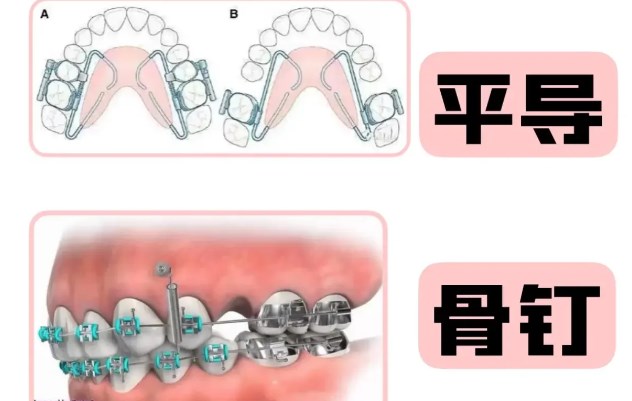 西安達芬琪口腔牙齒正畸案例分享：骨性齙牙拔牙矯正，術(shù)后側(cè)臉線條超驚艷，從“月亮臉”到標(biāo)準(zhǔn)側(cè)貌