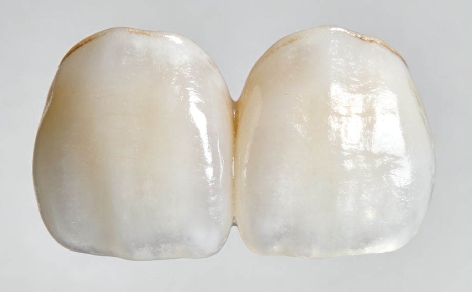 二、西安達芬琪口腔做牙貼面要多少錢受哪些因素影響