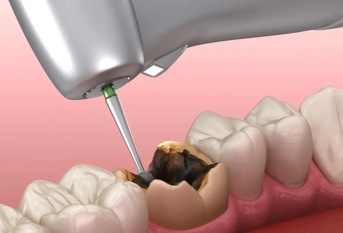 核心優(yōu)勢(shì)與補(bǔ)牙特點(diǎn)