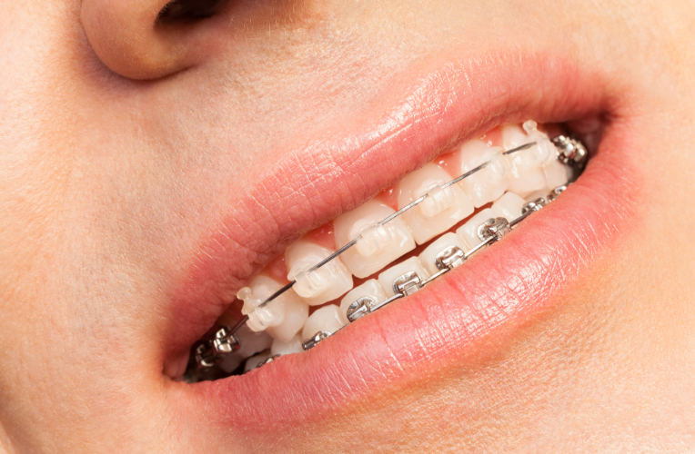 四、岳陽地區(qū)口腔正畸如何選擇：綜合對比技術(shù)與醫(yī)生