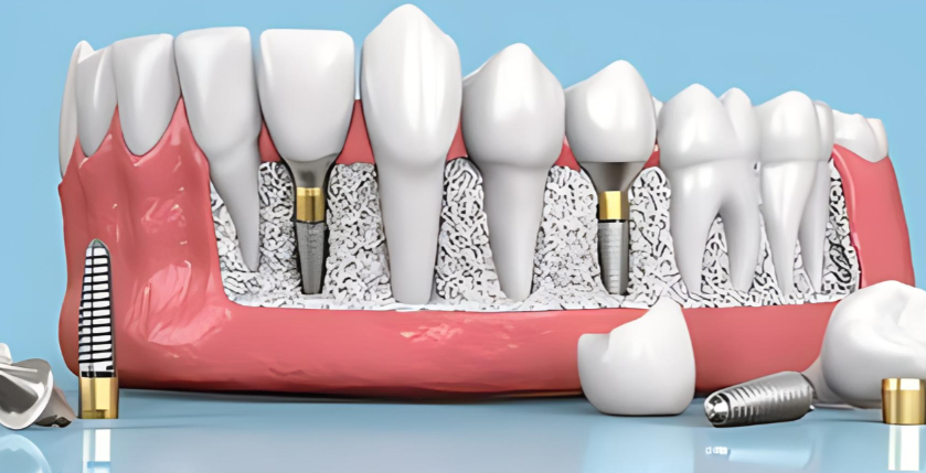 三、除了種植牙，其他項(xiàng)目烏魯木齊雙寶口腔醫(yī)院價(jià)格貴嗎？