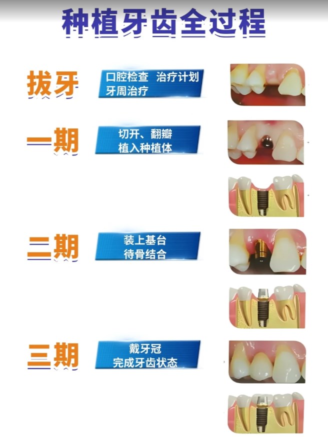 四、去江门侨邑口腔前，你还应该知道这些事