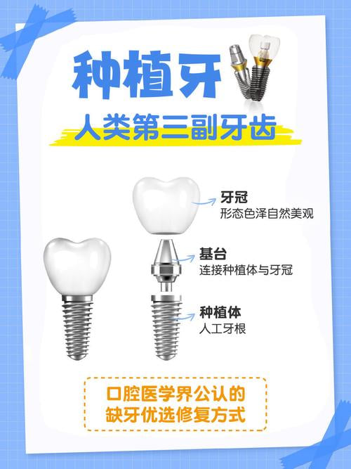 五、FAQ：关于潮州诺贝尔口腔种植牙，你可能问的5个问题