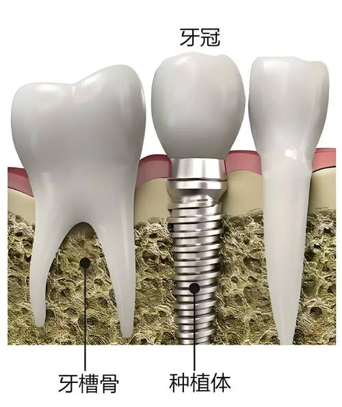 三、潮州诺贝尔口腔种植牙手术与变好亲历：那些网上没人细说的细节www.kelete.com