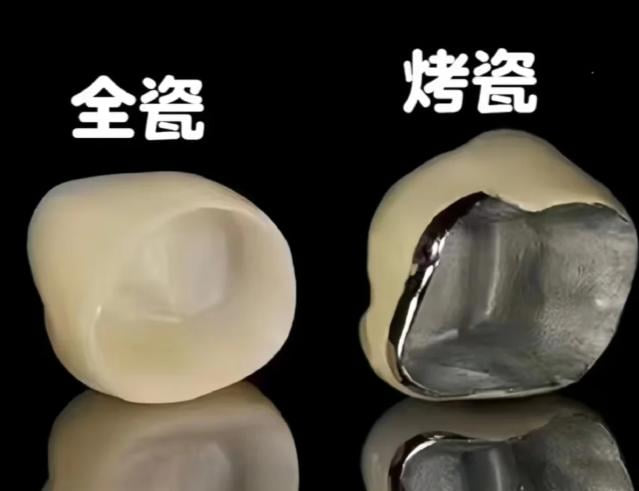 北京齿康烤瓷牙多少钱一颗？钴铬合金780起、全瓷1500起，选错材质牙龈容易黑！