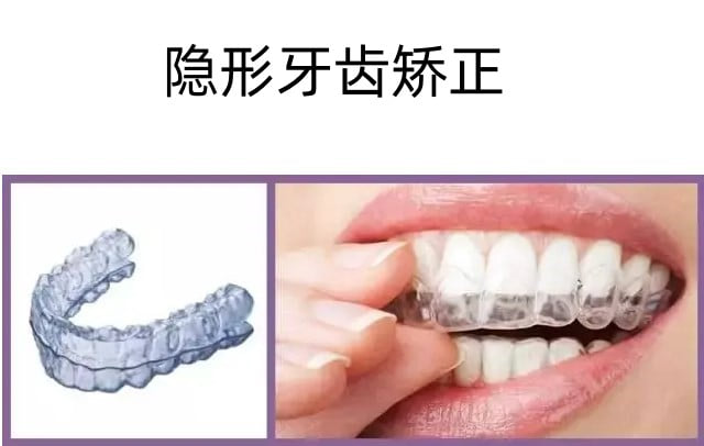 三、东莞口腔医院99元青少儿牙齿不齐公益筛查卡深度拆解