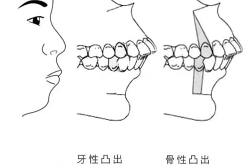 四、为什么暑期是青少年牙齿矫正的黄金时期