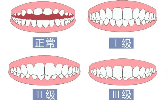 七、正畸期间日常饮食与口腔清洁的维护规范