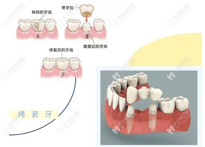 南京做烤瓷牙去哪家？美奥 / 博韵 / 茀莱堡 / 德牙联合价格对比，贝色小程序横向比价