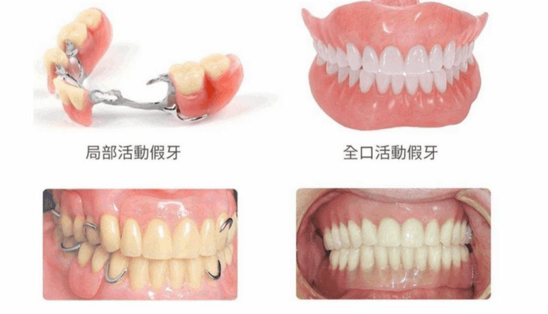 拒绝掉牙尴尬！上海皓芽口腔满口吸附性义齿真实体验：真的不磨嘴吗？