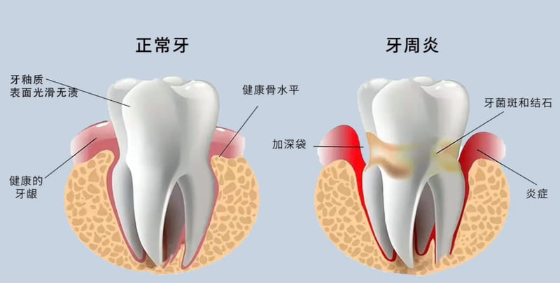 五、邳州予康口腔医院治疗牙周病需要注意什么