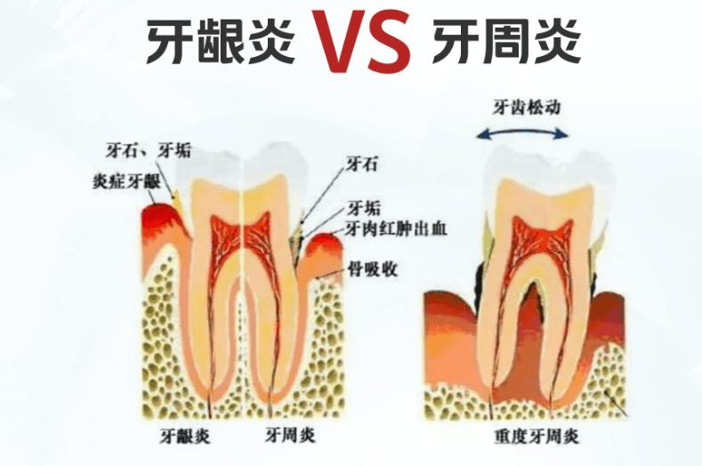 一、邳州予康口腔医院能治疗牙周病吗