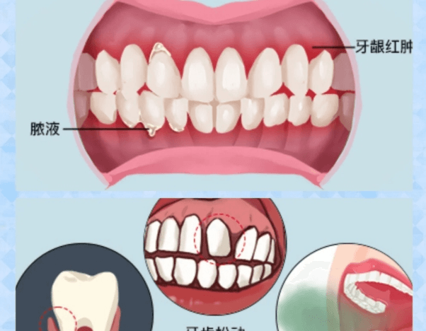 三、邳州予康口腔医院牙周病治疗的费用贵不贵