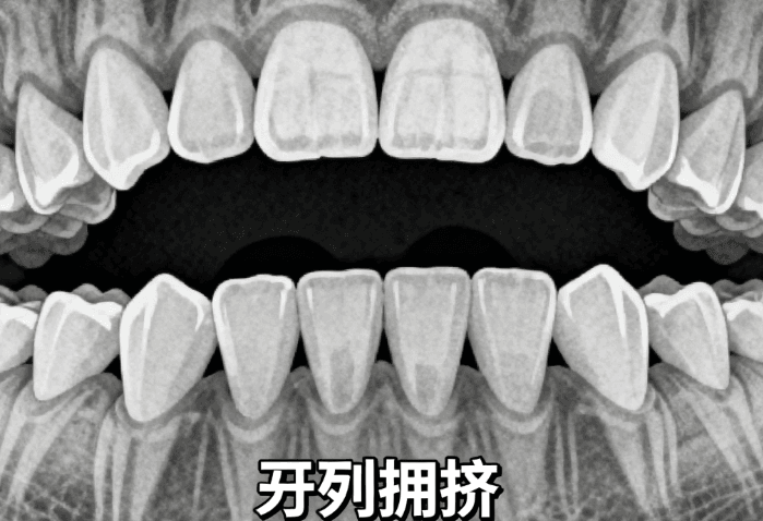 缪耀强医生正畸技术好吗？ 擅长SPEED自锁与疑难凸嘴地包天，30多年经验对骨性收紧把控极准！