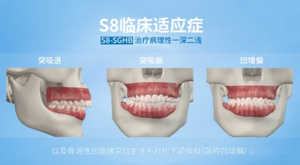 四、武汉皓诺口腔正畸适合哪些人?儿童、成人隐形、骨性龅牙分开看