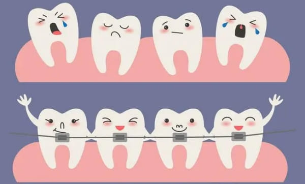 三、矫正牙齿是铁丝好还是隐形好?效果、疗程与成功几率对比