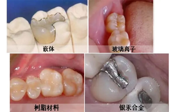 玉林阳光芽博士口腔怎样?亲测补牙380元全包,种牙2980起CT三分钟出图,环境好预约方便