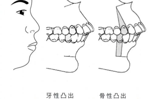 柳州中瑞口腔矫正牙齿多少钱?本地人亲测价格透明,基础8000元起,隐形矫正+提前贝色约更稳